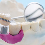 clinica dental zoco rivas. Existen multutid de tipos de implantes dentales según las necesidades