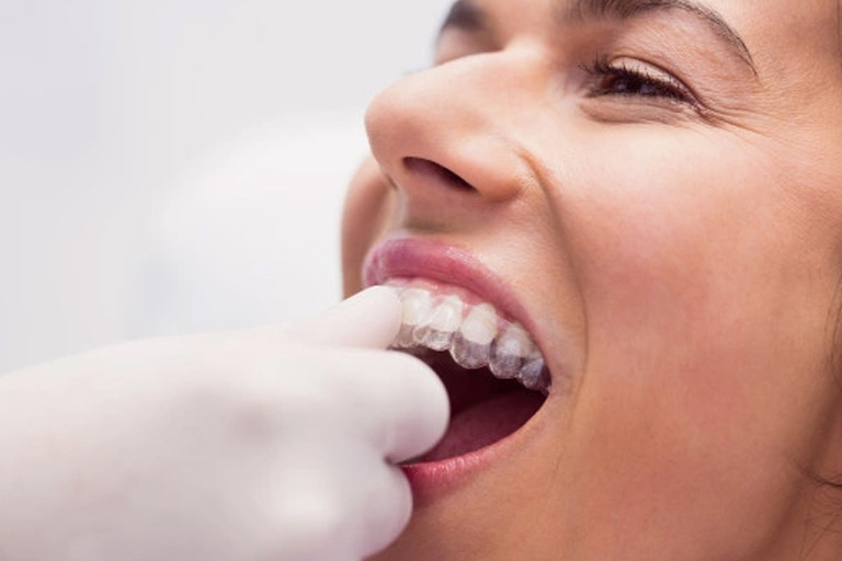 Clínica Dental Zoco Rivas. Los retenedores son parte importante de cualquier tratamiento de ortodoncia. Te explicamos como cuidar los retenedores dentales