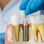 9 señales de que necesitas un implante dental. Implantes dentales en Rivas-Vaciamadrid