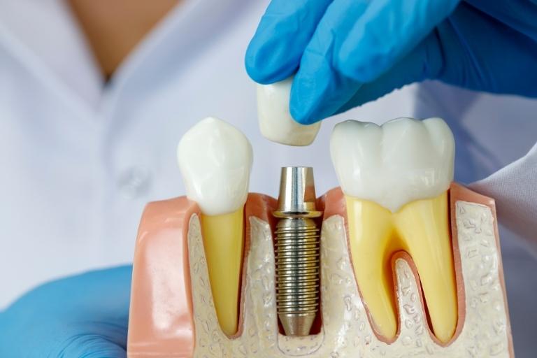 9 señales de que necesitas un implante dental. Implantes dentales en Rivas-Vaciamadrid