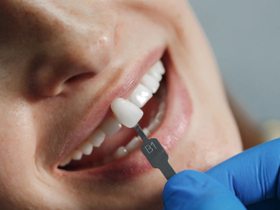 Soluciona la sensibilidad dental con carillas dentales