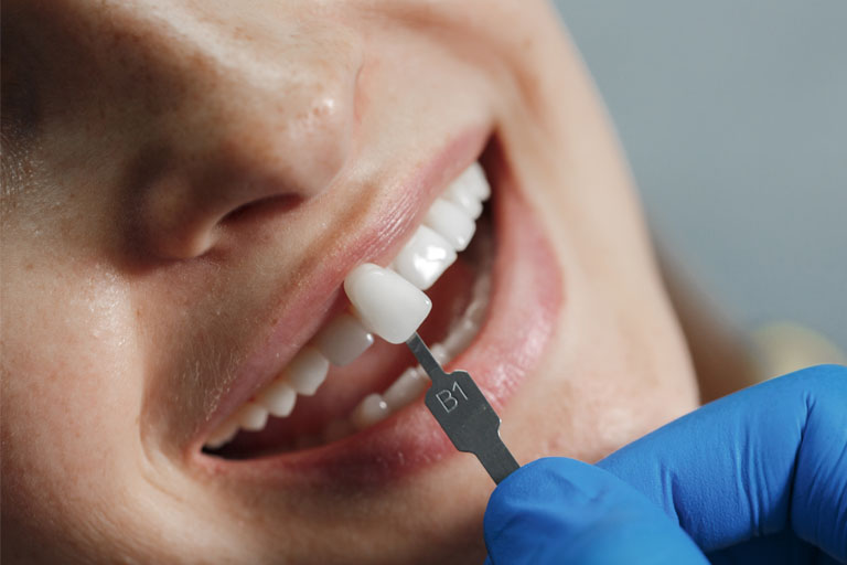 Soluciona la sensibilidad dental con carillas dentales