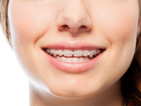 Brackets y problemas en las encías - Ortodoncia en Rivas-Vaciamadrid - Clínica Dental Zoco Rivas