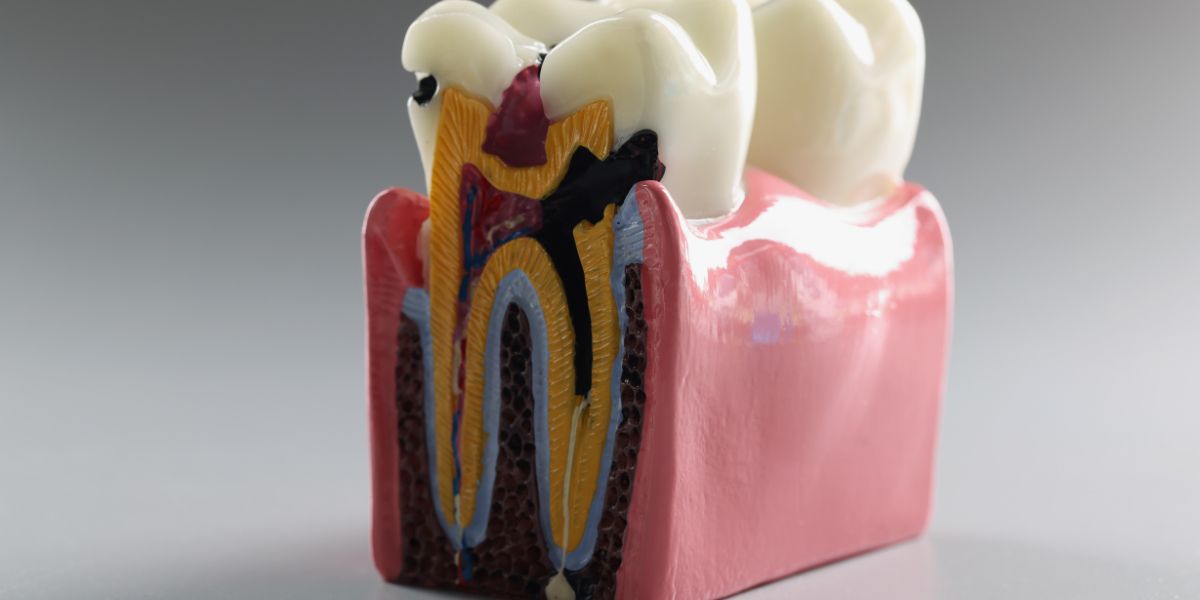 Infografía de caries dental, primera causa de empastes dentales - Clínica Dental Zoco Rivas