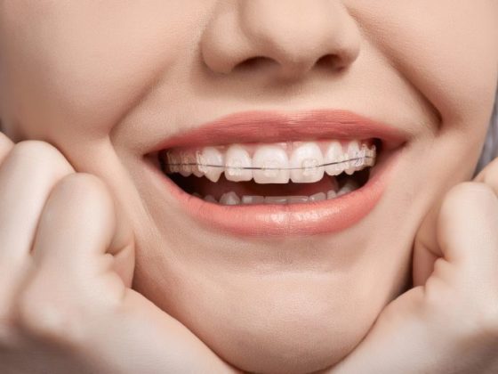 Mujer con brackets sonriendo - Cómo afectan los brackets en las encías - Clínica Dental Zoco Rizas - Ortodoncia en Rivas-Vaciamadrid