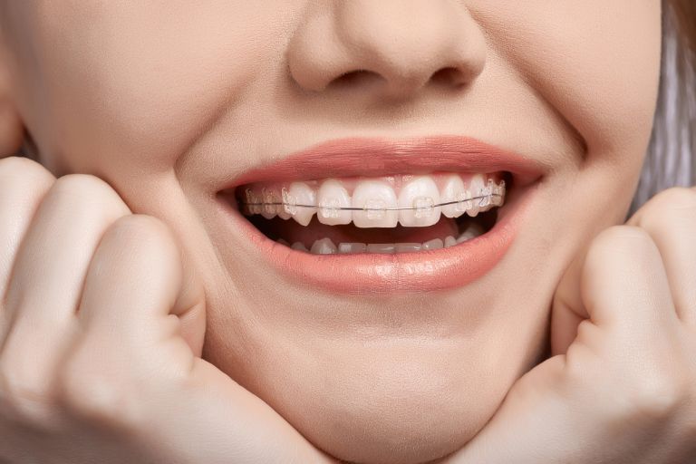 Mujer con brackets sonriendo - Cómo afectan los brackets en las encías - Clínica Dental Zoco Rizas - Ortodoncia en Rivas-Vaciamadrid