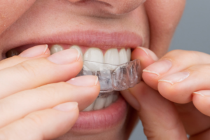 Clínica Zoco Rivas. Evita los riesgos de la ortodoncia invisible por internet